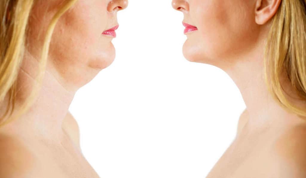 Double Chin treatment Chandlers Green before and after results