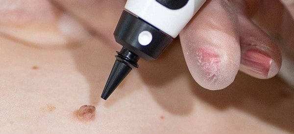 After Skin Tag Removal Chandlers Green