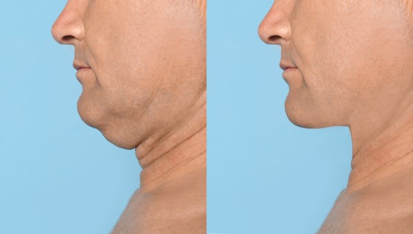 Which Non-Surgical Treatments Work Best for Jowls and Loose Skin Chandlers Green?