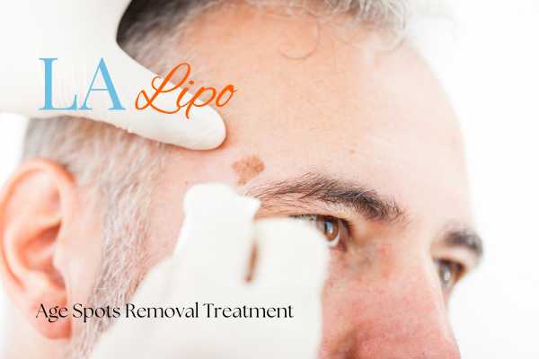 What Are the Most Effective Treatments for Age Spots Chandlers Green?