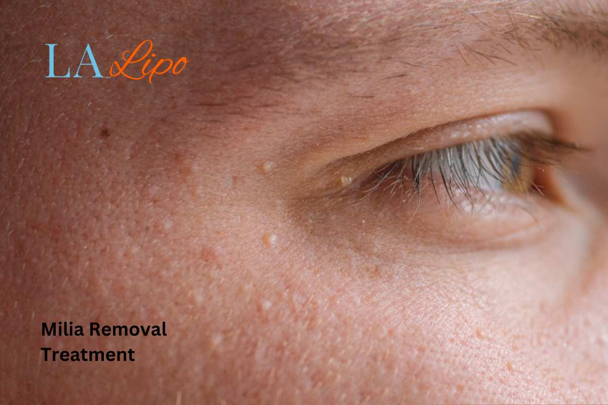 Cryopen Milia Removal: Is It the Easiest and Safest Option Chandlers Green?