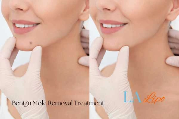 woman's before and after mole removal Chandlers Green results