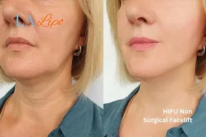 hi-fu for wrinkles Chandlers Green before and after results