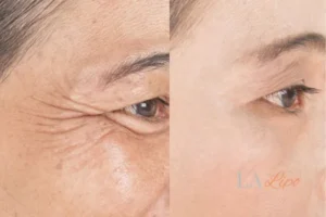 Before and after results of woman - HI-fu wrinkles reduction treatment Chandlers Green