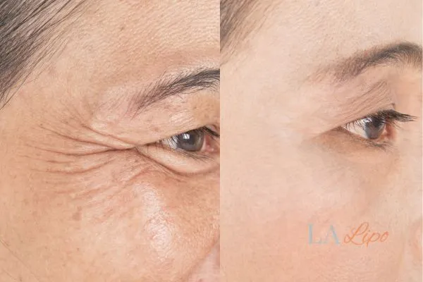 Before and after results of woman - HI-fu wrinkles reduction treatment Chandlers Green