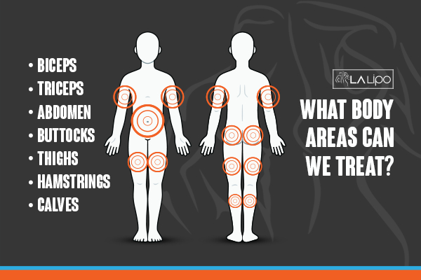 Graphic to show areas you can have LA-EMS Body Sculpting Chandlers Green treatment.
