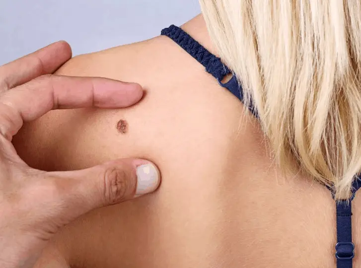 woman having mole removal Chandlers Green consultation before treatment.
