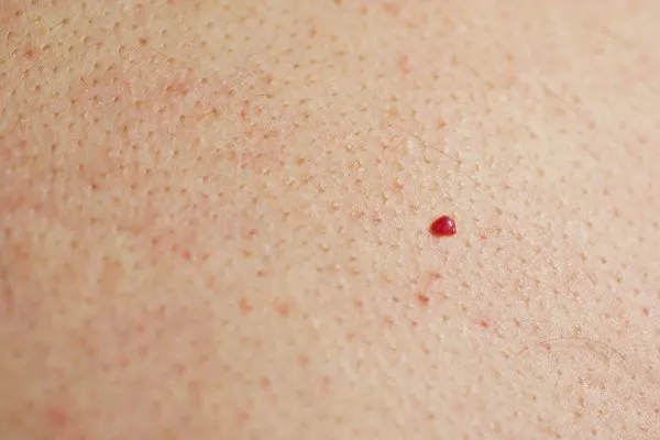 close up of a cherry angioma Chandlers Green