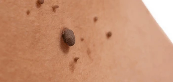 image of a skin tag Chandlers Green