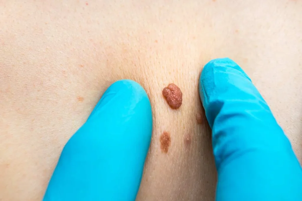 Consultant examining a skin tag Chandlers Green