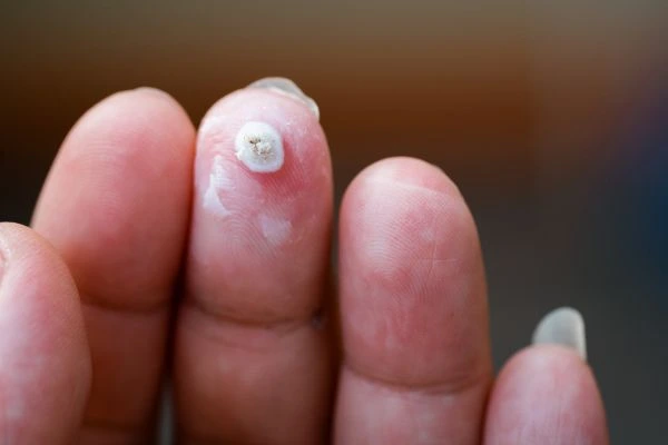 wart on person finger - cryotherapy to treat from LA LIPO Chandlers Green