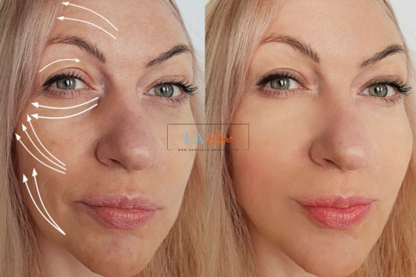 Morpheus 8 results Chandlers Green face lift.