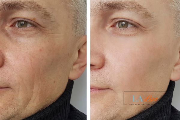 See the amazing results of Morpheus8 Treatment Chandlers Green!