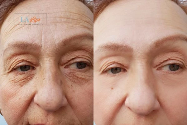 The powerful benefits of Morpheus8 Treatment Chandlers Green - Call Our team today!