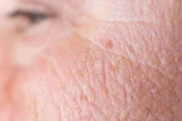 close up picture of a woman's face showing an age spot Chandlers Green