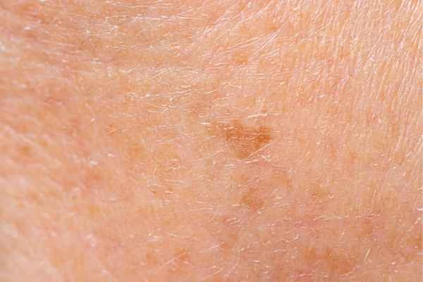 close up picture of age spots Chandlers Green