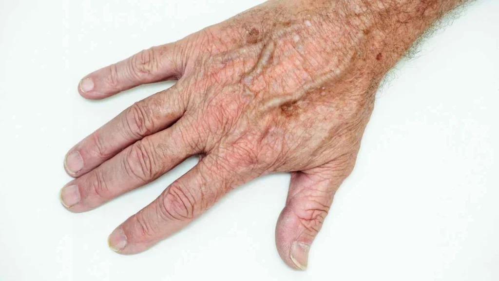 Male hand showing age spot Chandlers Green